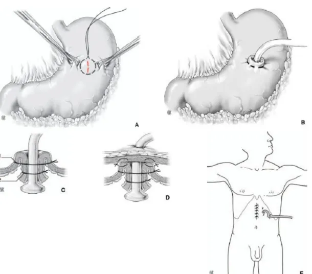 Figure 12 : gastrostomie directe de type Fontan 