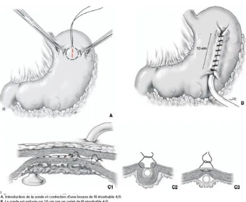 Figure 13 : gastrostomie indirecte de Witzel 
