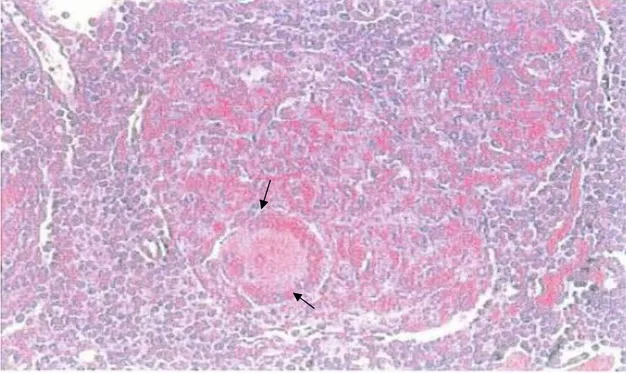 Figure 1 : granulome sarcoïdosique [1]. Ce résultat positif d'une biopsie ganglionnaire     périphérique montre un granulome , composé de cellules épithélioïdes et d'une cellule géante  multinucléée de type Langhans (en bas au centre)