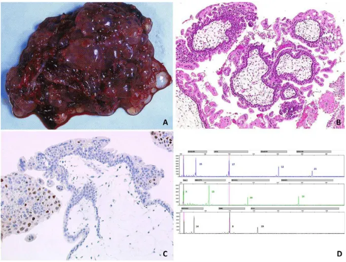 Figure 9: A. Aspect macroscopique en « grains de raisin » de la MHC. 