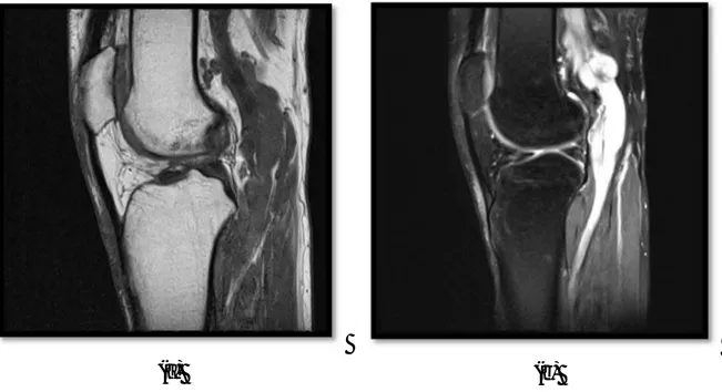 Figure 1 : IRM du genou droit montrant une masse des parties molles du compartiment  interne du genou droit englobant les tendons de la patte d’oie qui sont continus mais écartés 