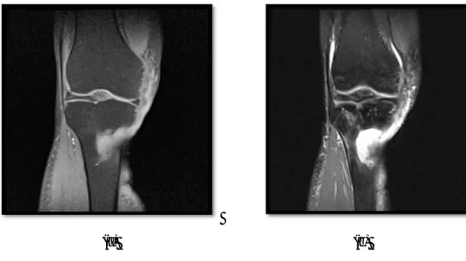 Figure 2 : IRM du genou droit montrant une réapparition de la masse des parties molles  internes du genou droit avec une extension osseuse cortico-médullaire en regard