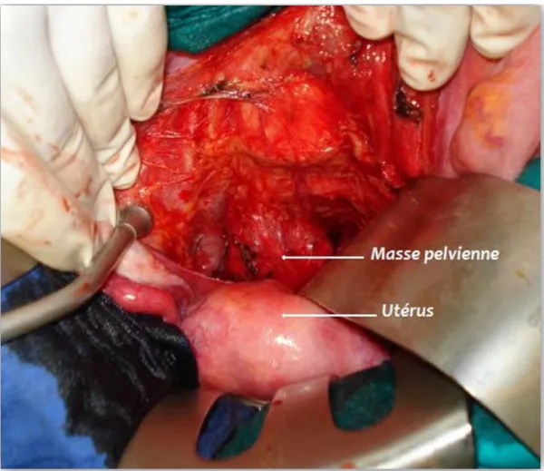 Figure  14.  Vue  opératoire  après  la  dissection  de  l’espace  rétrorectal  montrant le bourgeon tumoral encapsulé 