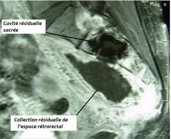 Figure  19.  IRM  pelvienne  de  contrôle  objectivant  une  cavité  résiduelle  sacrée communiquant avec une collection rétrorectale 