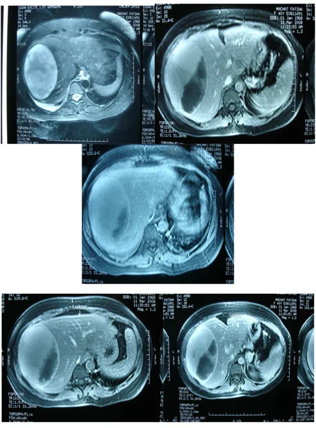 Figure 2 : IRM abdominale : une masse ovalaire en faveur d’un hématome sous  capsulaire spontané du foie