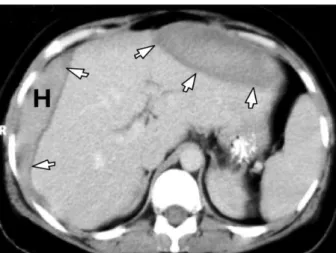 Figure 5 : TDM abdominale qui montre un hématome sous capsulaire du foie avec une  hyperdensité à droite correspondant à un saignement aigu.[105] 