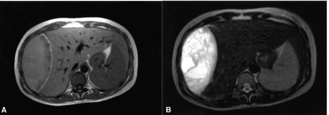 Figure 6 : IRM abdominale en coupe axiale montrant : une image ovalaire hyperintense  en T1 (B) et hypointense en T2 (A) évoquant un hématome sous capsulaire du foie .[105] 