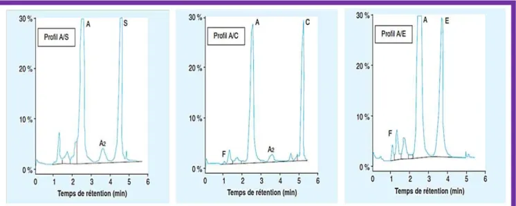 Figure 8 : Exemples de profils en chromatographie liquide haute performance sur colonne  échangeuse de cations (Programme β-thal short, Bio-Rad®) [18] 
