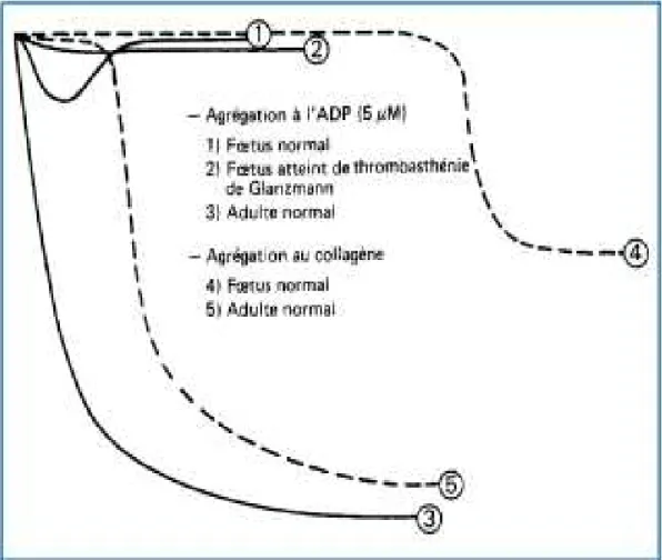 Figure 4 : Agrégation plaquettaire fœtale  [14].