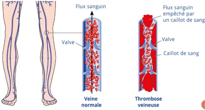 Figure 1 : Formation d’une thrombose veineuse [13]. 