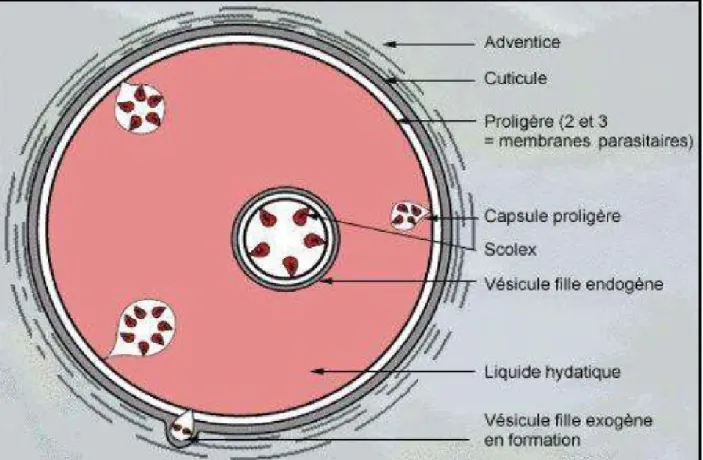 Figure n° 4 : Kyste hydatique avec larves (scolex) d’échinococcus granulosus [13]