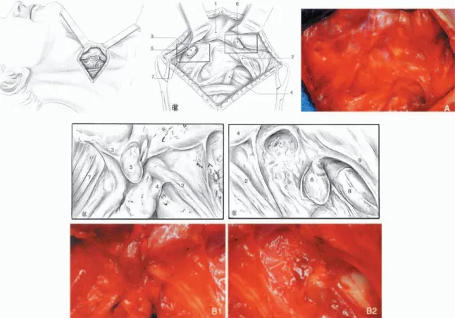 Figure 3: Anatomie macroscopique (Vues opératoires de glandes parathyroïdes  normales) [15]