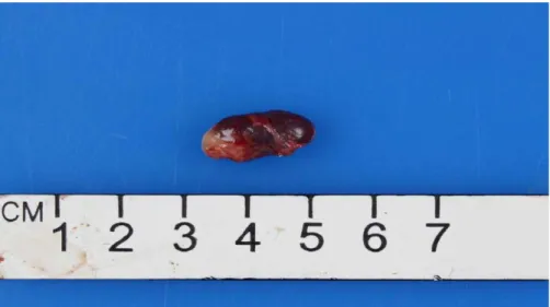 Figure 8 : Glande parathyroïde élargie en forme de rein avec une fine capsule fibreuse et  une vascularisation importante[43]