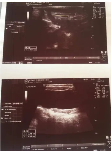 Figure N°33 : Echographie 