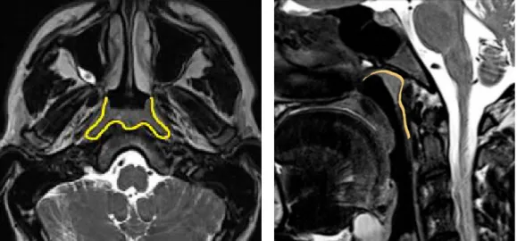 Figure 4: Radio anatomie normale en coupes axiale et sagittale IRM centrées sur le  cavum