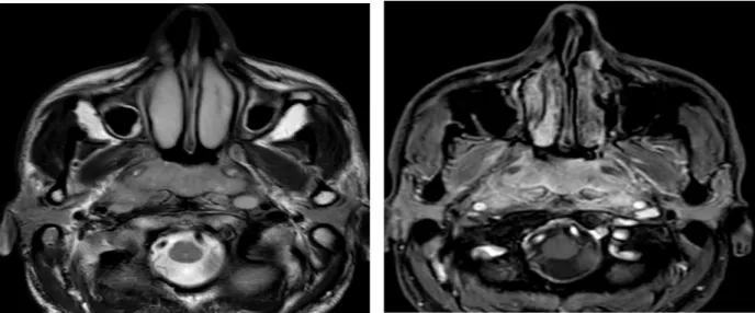 Figure 12: UCNT stade T3. TDM du cavum. 