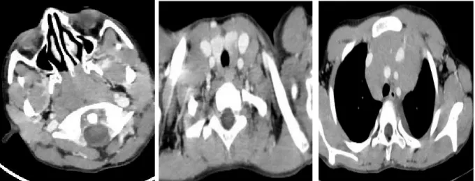 Figure 20: Lymphome de Burkitt. TDM du cavum 