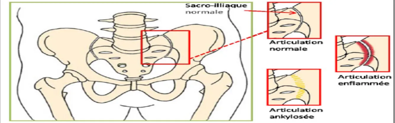 Figure 2 : Schéma d’une articulation sacro-iliaque normale, enflammée et ankylosée (29)