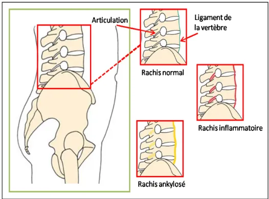 Figure 3 : Schéma du rachis normal, inflammatoire et ankylosé (29). 