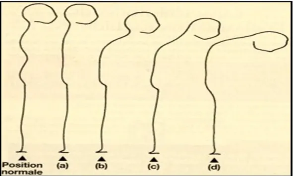 Figure 4: Signes de l’ankylose rachidienne (29). 
