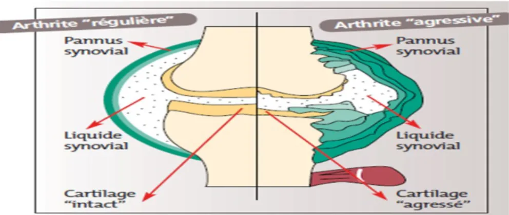 Figure 6 : Schéma d’une articulation normale et arthritique (29). 