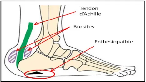 Figure 7: Schéma d’une enthèse calcanéenne.(29) 