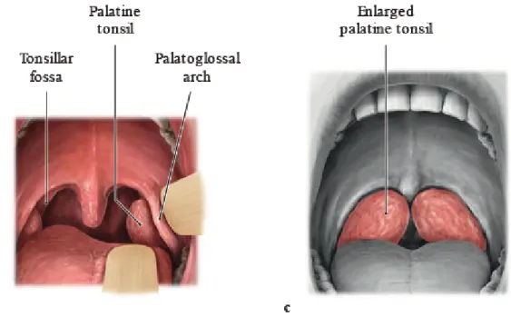 Figure 4 : Vues antérieures de la cavité buccale montrant des amygdales palatines de  volume normal sur b et des amygdales hypertrophiées sur c [1] 