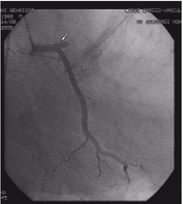 Fig. 2 : Coronarographie montrant une occlusion complète de l’artère   interventriculaire antérieure 