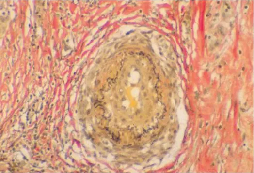 Figure 21:  Vascularite sévère dans le tissu sous-cutané d’une lésion de l’ulcère de Buruli  [78]
