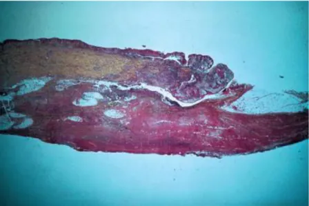 Figure 26:  Echantillon de biopsie provenant du bord d’un ulcère de Buruli et montrant le  décollement du derme et une nécrose massive de l’épiderme, du derme, de l’hypoderme 