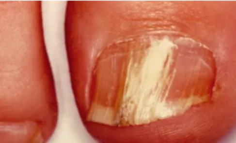 Figure 5:Onychomycose proximale. (24) 