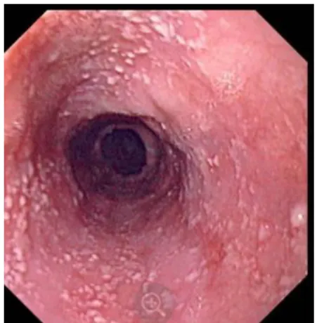 Figure 12:candidose œsophagienne. (12) 
