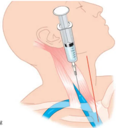 Figure 8 : Ponction de la veine jugulaire interne : voie de Daily [45]. 