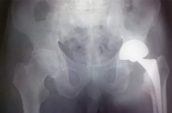 Figure 14 : radiographie du bassin de face montrant   un déscellement aseptique à gauche [108] 