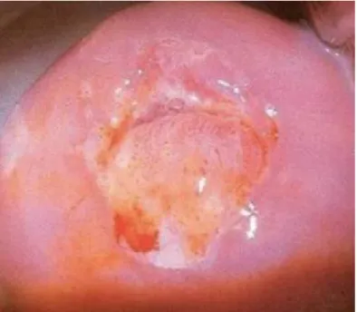 Figure 16: Cervicite purulente à N. gonorrhoeae [130] 