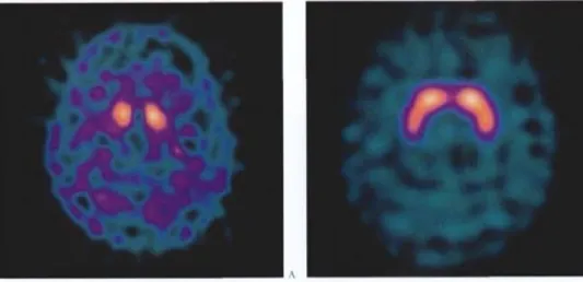 Figure  16 : Tomographie par émission de positons montrant le flux sanguin cérébral[18] 