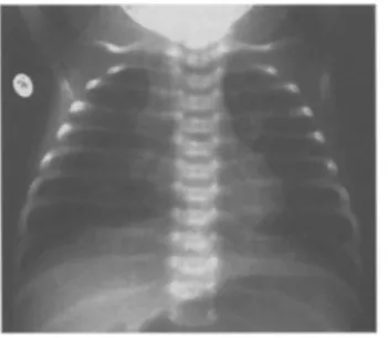 Figure 7 : Pneumopathie interstitielle  bilatérale diffuse (nouveau-né de 1 mois) [68] 