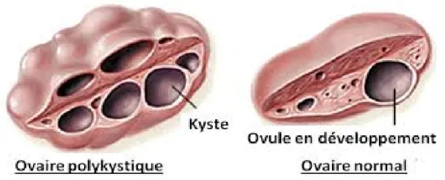 Figure 7 : Syndrome de l'ovaire polykystique 