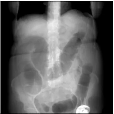 Figure 8 : Cliché d’ASP de face debout montrant la distension colique 