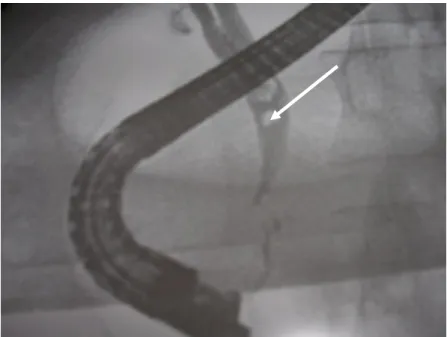 Figure 8 : vue endoscopique d`un sphincterotome au cours d`une SBE chez une patiente atteinte  de PA