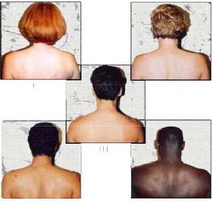 Figure 26 : cinq types de peaux selon leur réaction  lors d'une  exposition solaire  [6] 