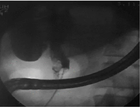 Figure 24 : CPRE montrant une voie biliaire dilatée en amont d’une sténose  Serrée du cholédoque et contenant plusieurs images lacunaires
