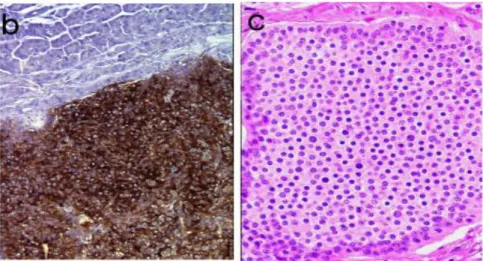 Figure 8 :  Aspects  typiques  de  tumeurs  neuroendocrines  bien  différenciées  de  l’intestin   grêle  au microscope optique 