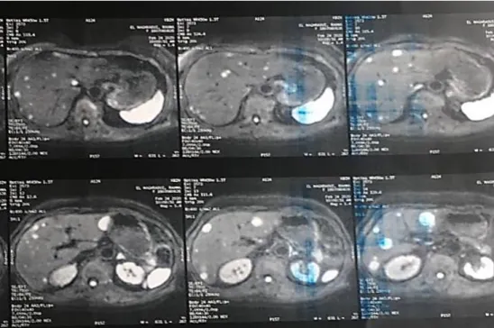 Figure 11 : Images de l’IRM hépatique de la patiente faite après une année du geste chirurgical