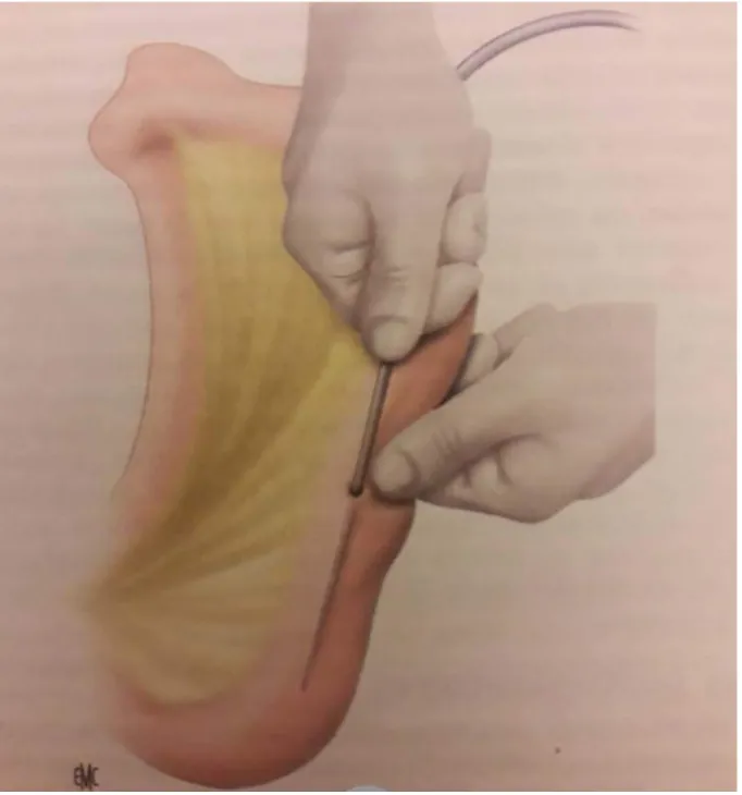 Figure 9 : jejunostomie à l'aiguille.