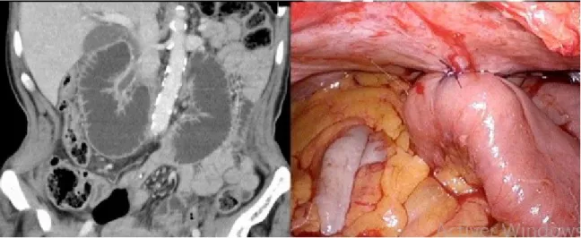 Figure 11 : volvulus jejunal sur le site d'une jejunostomie d'alimentation. Vue per operatoire.