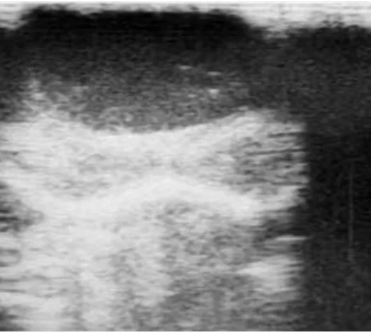 Figure 6 : Echographie de la masse montrant une formation arrondie liquidienne bien  limitée, occupant les 2/3 de la partie ventrale de la langue