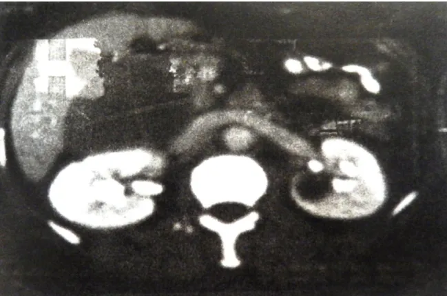 Fig 2 : TDM abdominale montrant la lésion kystique   de la tête du pancréas (observation 2) 