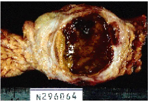 Fig 6 :Pièce opératoire ouverte : cystadénome mucineux (CM) de 8 cm de diamètre d'allure  bénigne