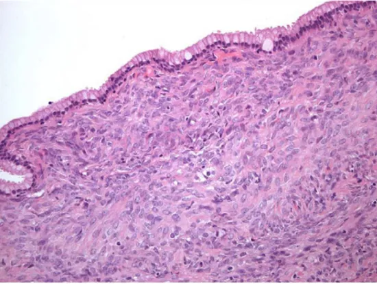 Fig 12 : Cystadénome mucineux (CM) bordée par une seule couche   de cellules épithéliales cylindriques sécrétant la mucine